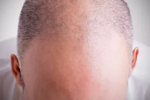 hair loss 2 Hair loss and baldness