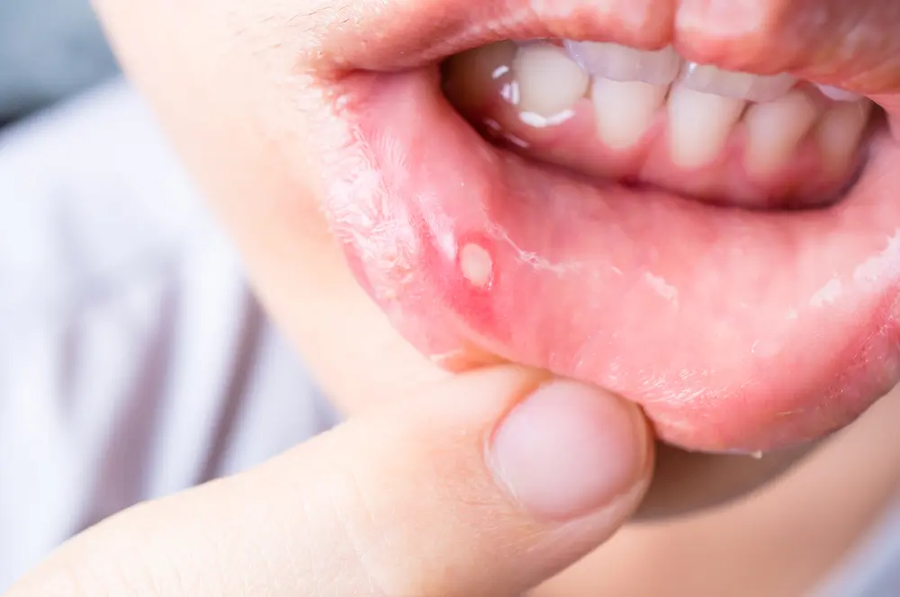 mouth ulcer after quitting tobacco What causes mouth ulcers?