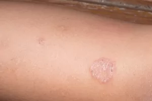 ringworm ringworm