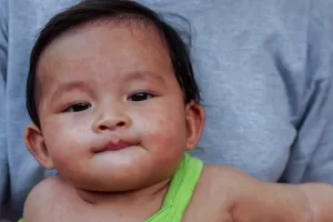 measles what causes mouth ulcers? are mouth ulcers contagious?