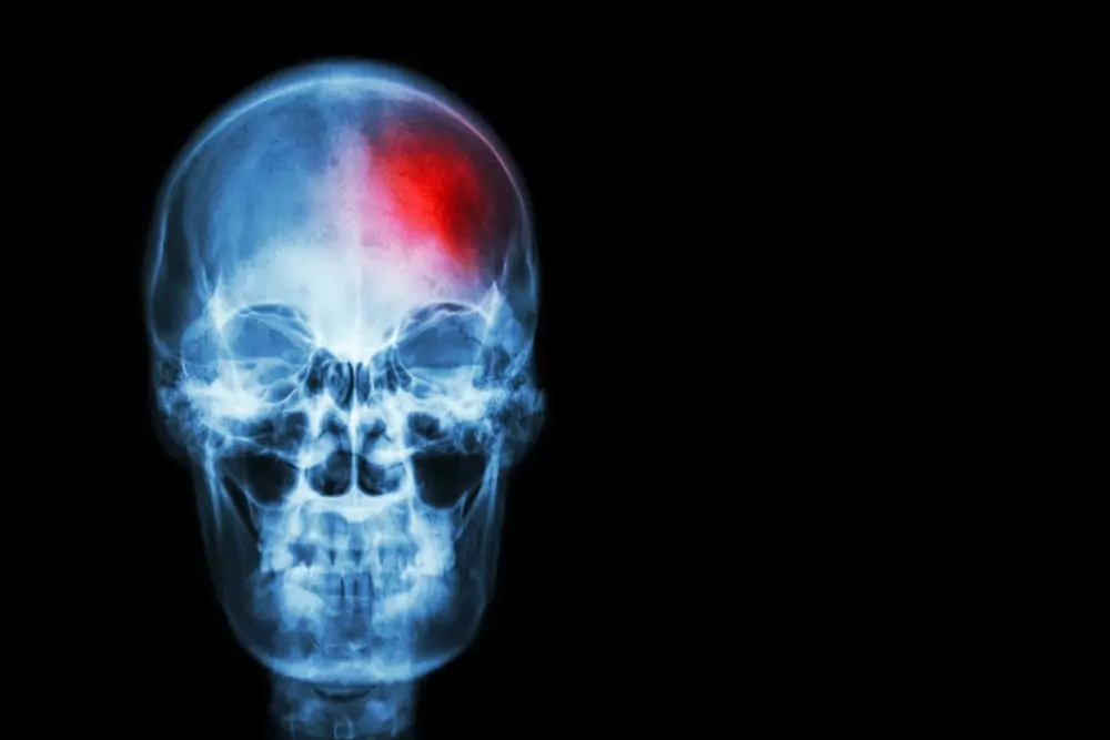 stroke3 what are the symptoms of a stroke