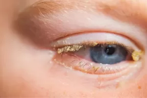 conjunctivitis