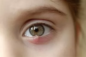 stye