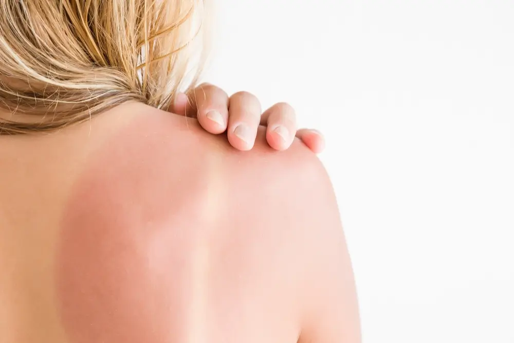 sunburn2 gastro