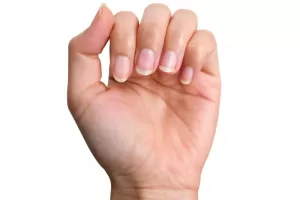 nail infection