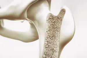 Osteoporosis