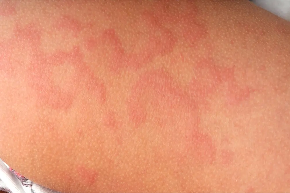 urticaria1 A close up picture of a person who as hives, also known as urticaria. But what causes urticaria?