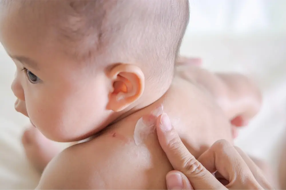 school sores 2 a baby who is getting treatment for school sores (impetigo)