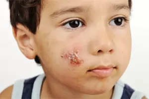 what are school sores and how do you treat school sores