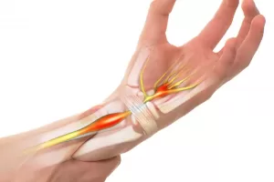 A diagram/ilustration showing the anatomy of the wrist, and the causes of Carpal Tunnel Syndrome.