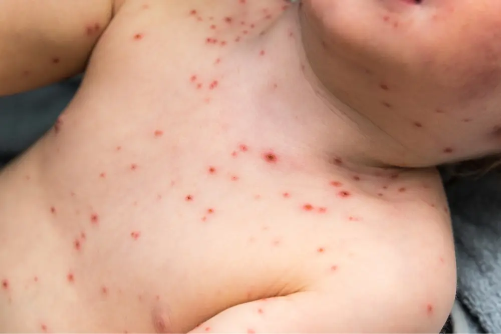 chicken pox 2 gastro