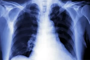 are xrays dangerous?