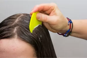head lice 1 How to treat Head Lice