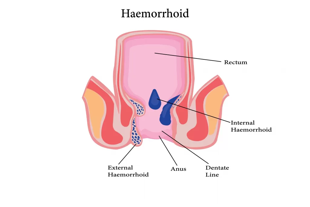 Illustration-of-the-rectum-and-anal-canal-showing-internal-and-external-haemorrhoids-scaled Illustration of the rectum and anal canal showing internal and external haemorrhoids