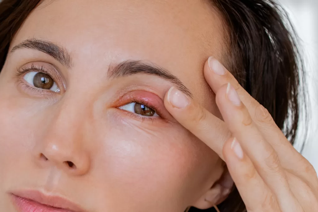 Close up female patient’s infected eye with blepharitis Close up female patient's infected eye with blepharitis