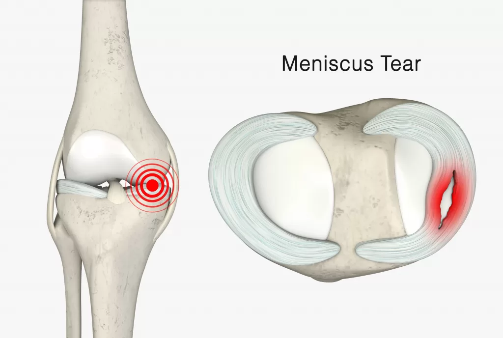 Meniscus-Tear-3D-Rendering-scaled Meniscus Tear 3D Rendering