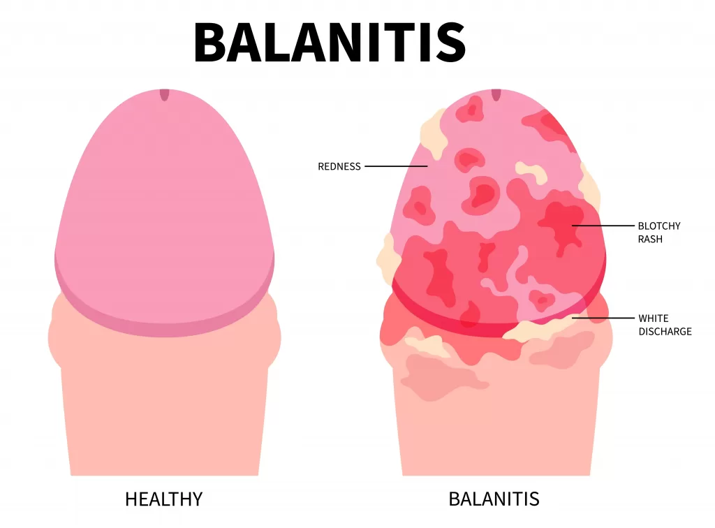Balanitis: Signs, triggers, and how to treat it - Qoctor your quick online  doctor