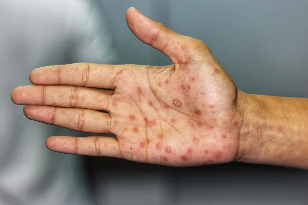 Secondary stage syphilis sores (lesions) on the palms of the hand Secondary stage syphilis sores (lesions) on the palms of the hand