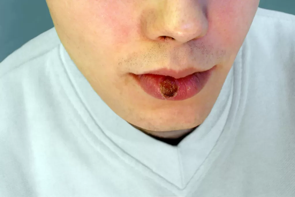 primary syphilis – indurated chancre on the lip primary syphilis - indurated chancre on the lip