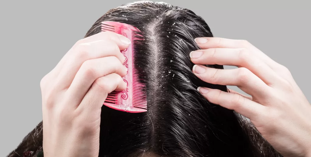 Woman removes dandruff from black hair with a comb Woman removes dandruff from black hair with a comb