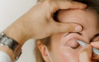 Blepharoplasty markup close-up on the face before the cosmetic surgery operation for modifying the eye region